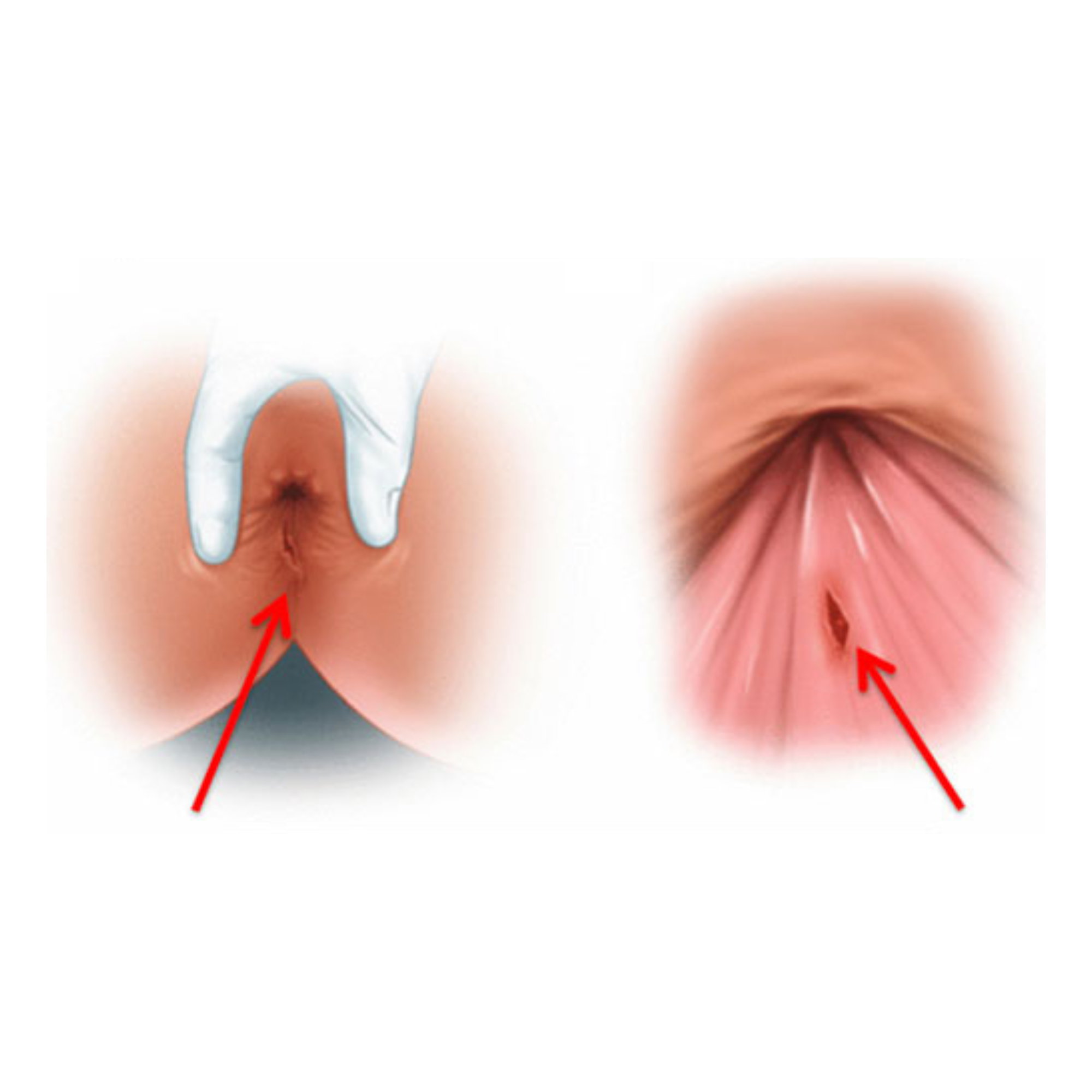 An anal fissure — a small tear in the lining of the anal canal