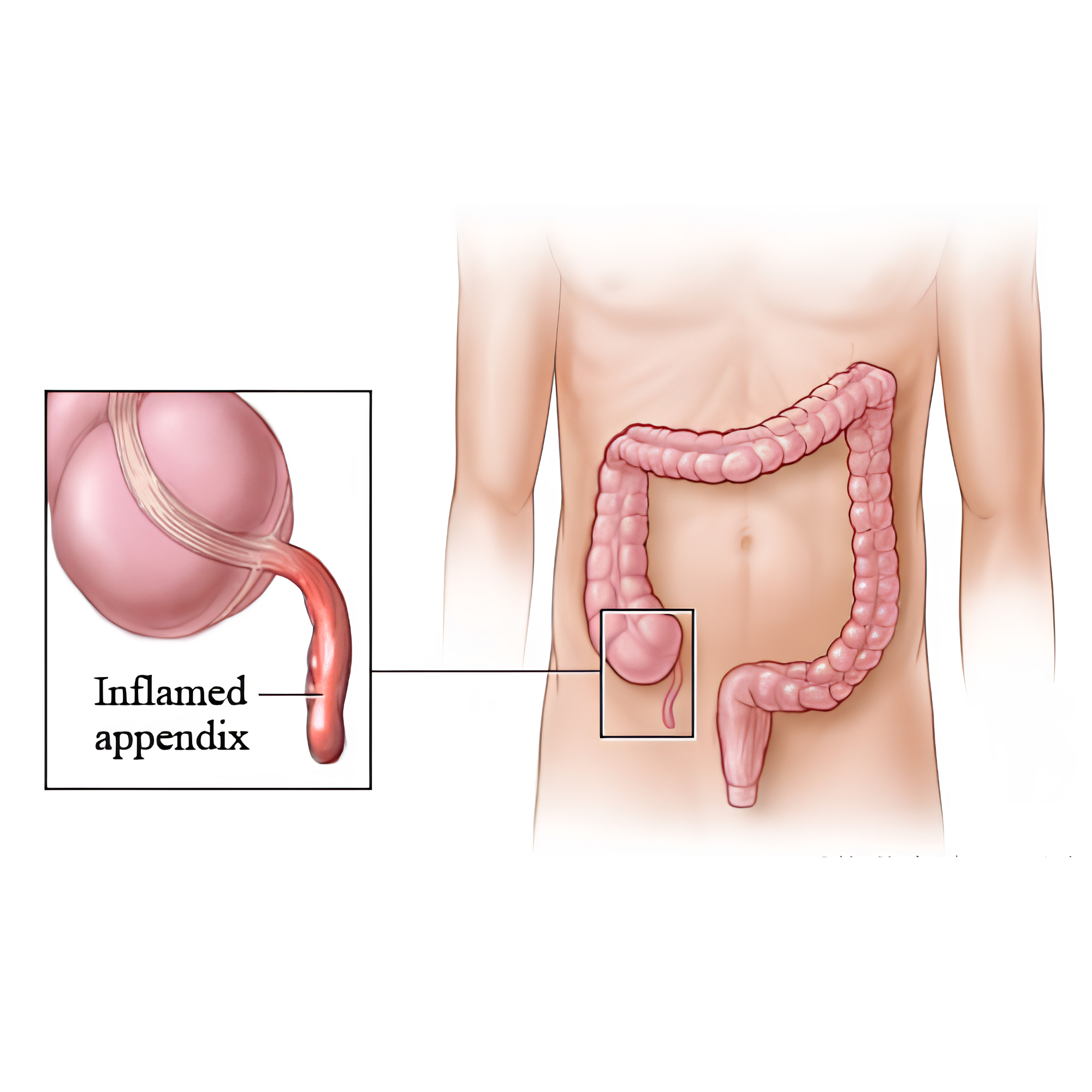 Appendicitis — inflamed appendix shown in body context with magnified view