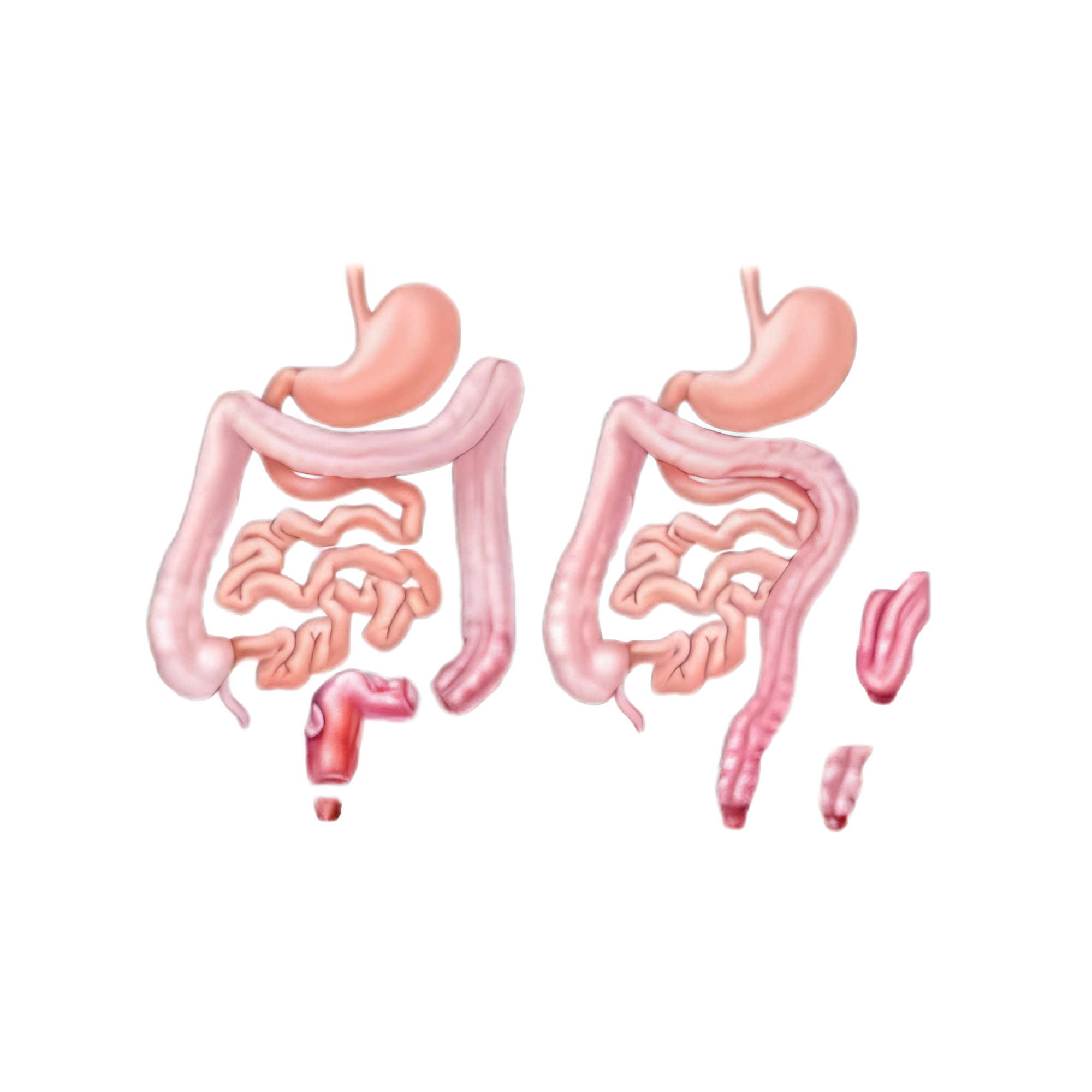 Bowel anatomy showing the lower rectum — the segment that can prolapse through the anal canal
