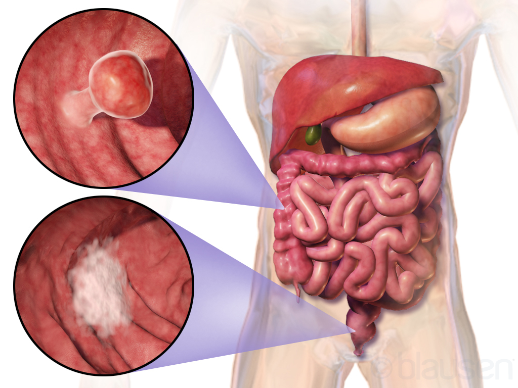 Colorectal cancer — lesions in the bowel shown in detail against the full digestive system
