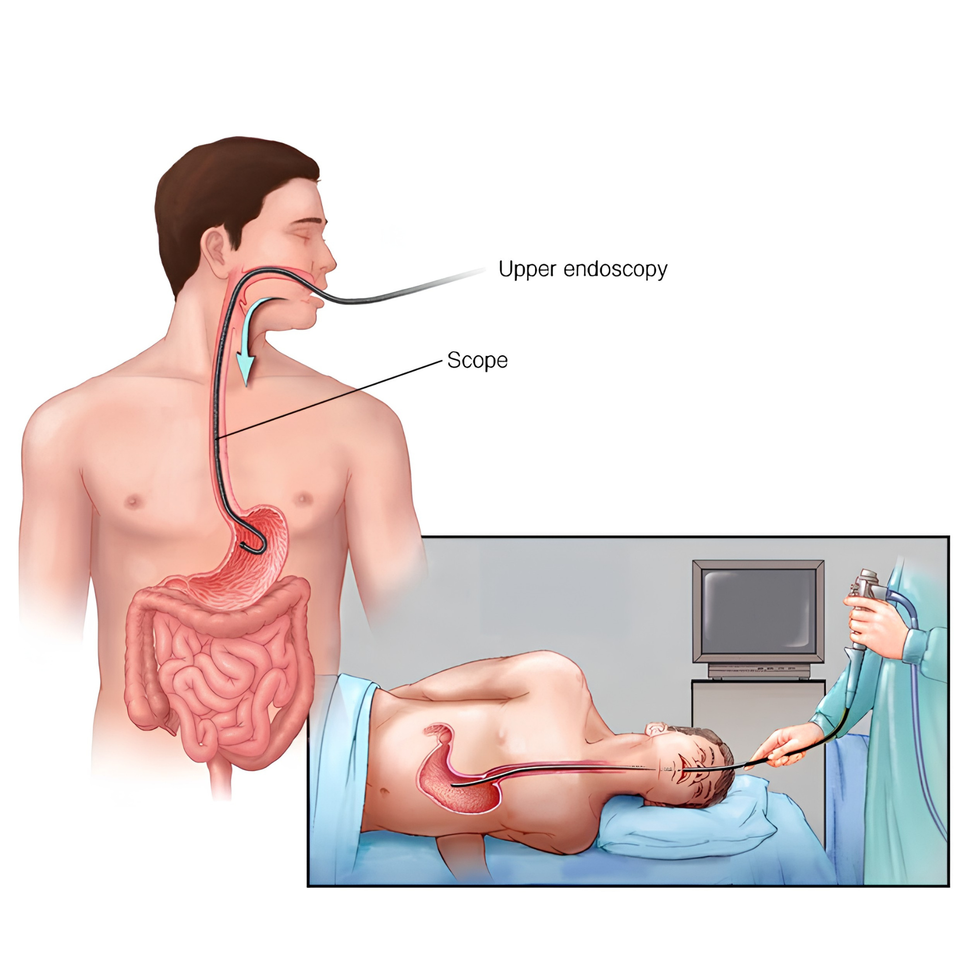 Upper-GI endoscopy (OGD / gastroscopy) — the scope is passed through the mouth to examine the oesophagus, stomach and duodenum