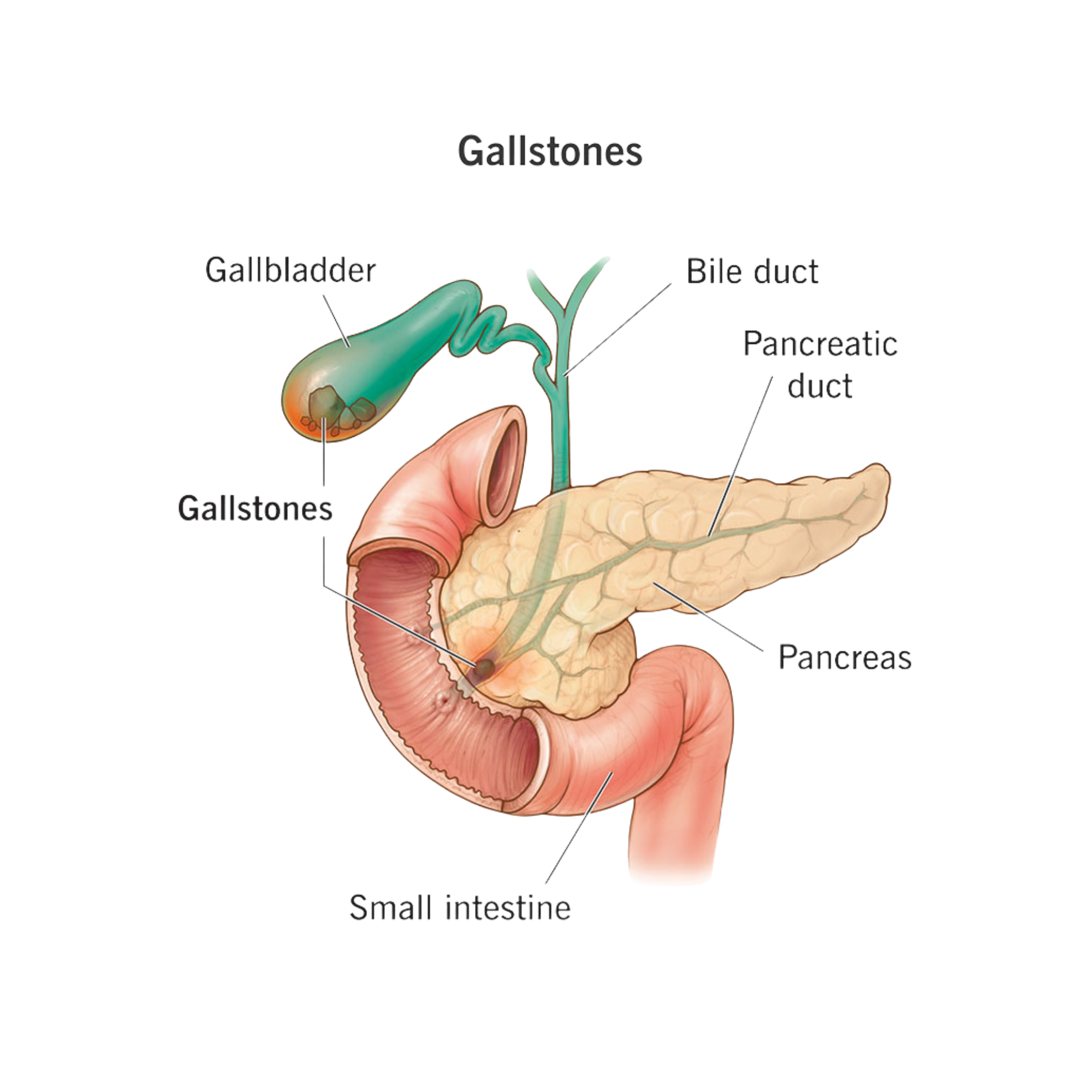 Gallstones anatomy — gallbladder, bile duct, pancreas and small intestine