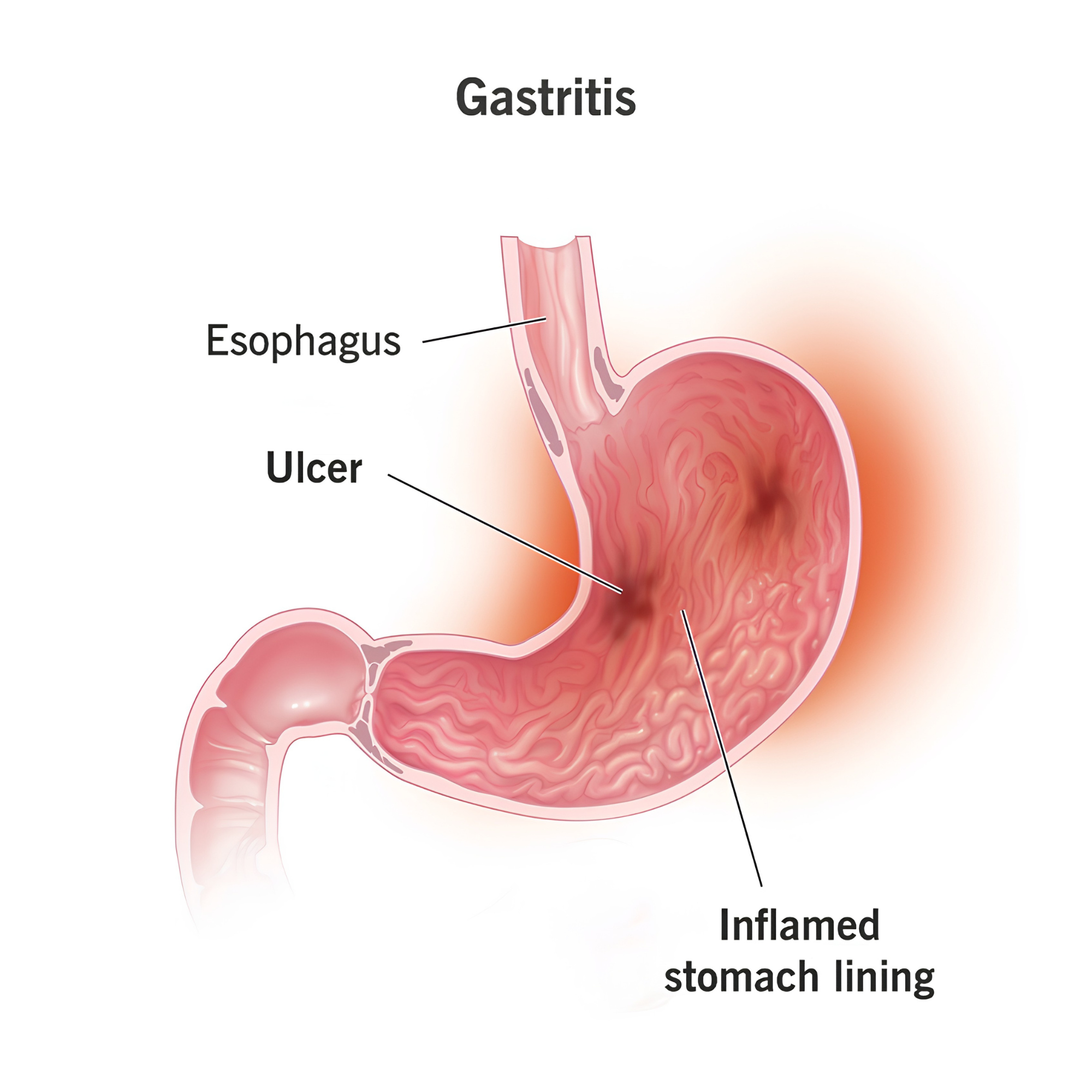 Gastritis — inflammation and ulceration of the stomach lining