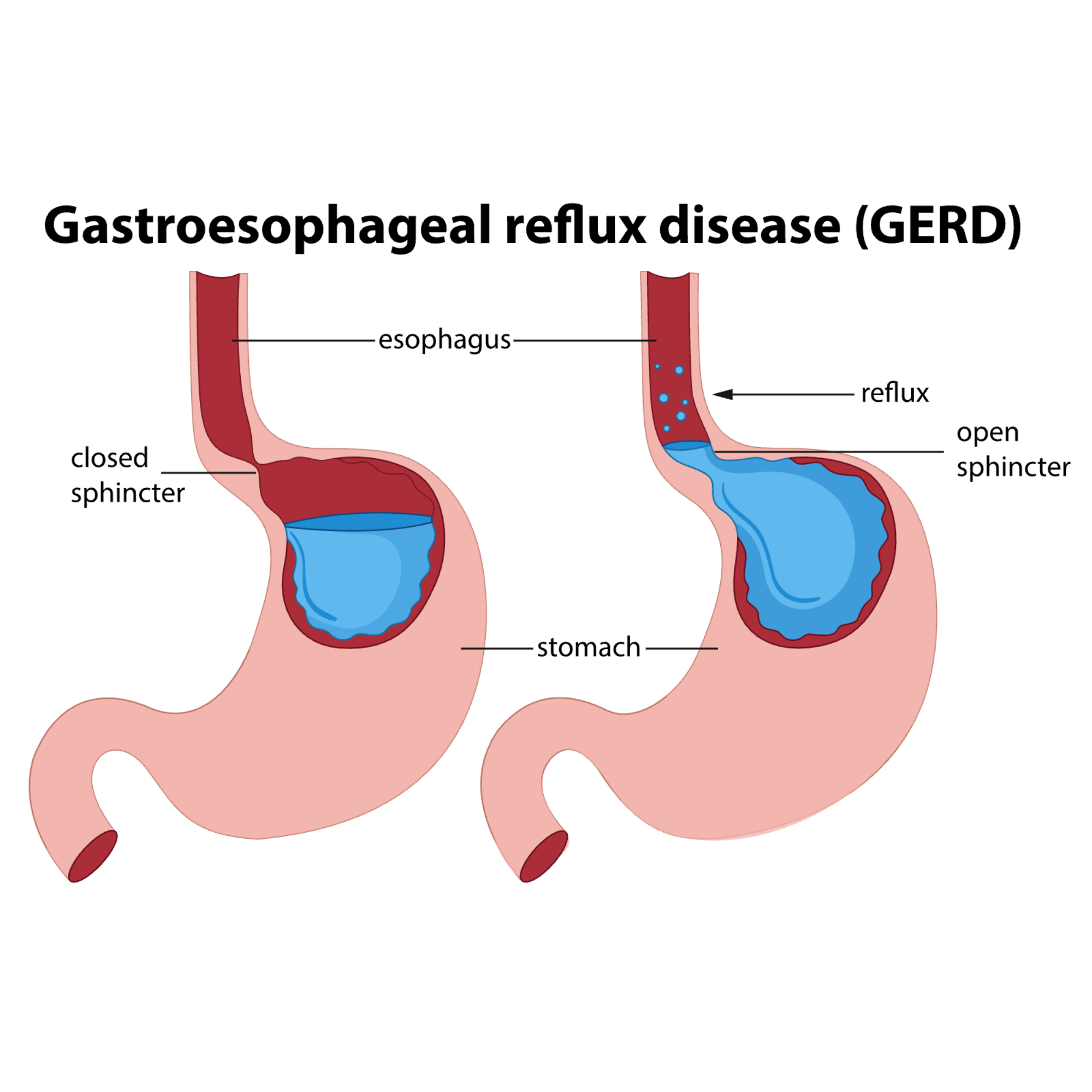 Closed and open sphincter — the mechanism of gastro-oesophageal reflux disease