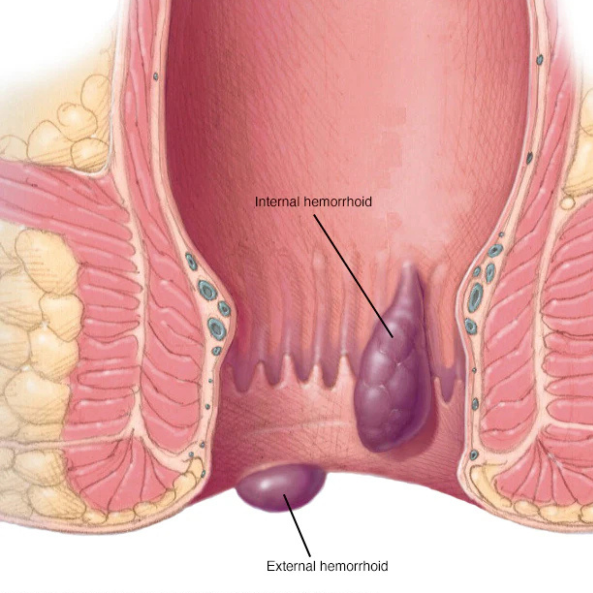 Internal and external haemorrhoids — swollen blood vessels in the lower rectum and anus