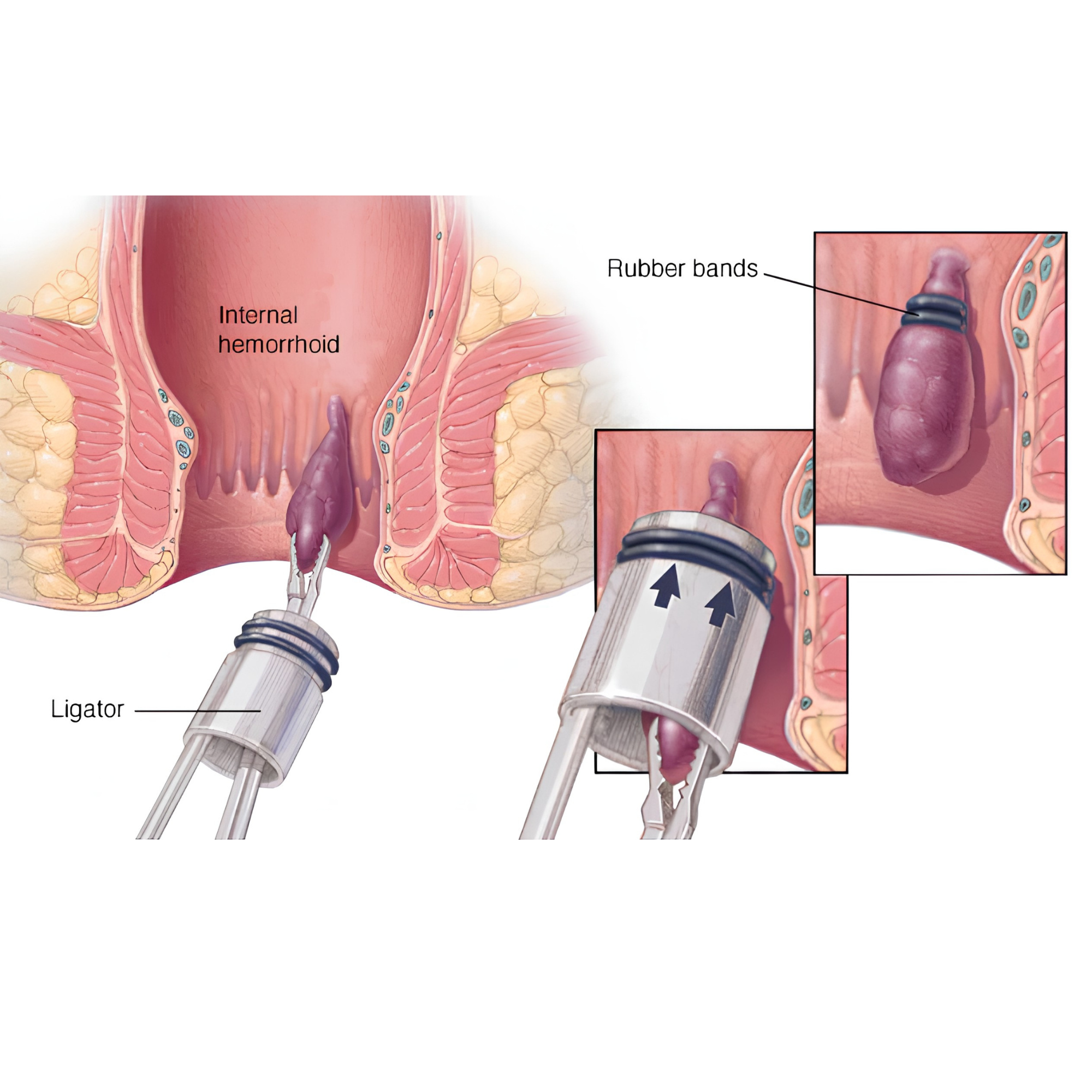 Rubber band ligation of an internal haemorrhoid — the ligator device places a band at the base of the haemorrhoid