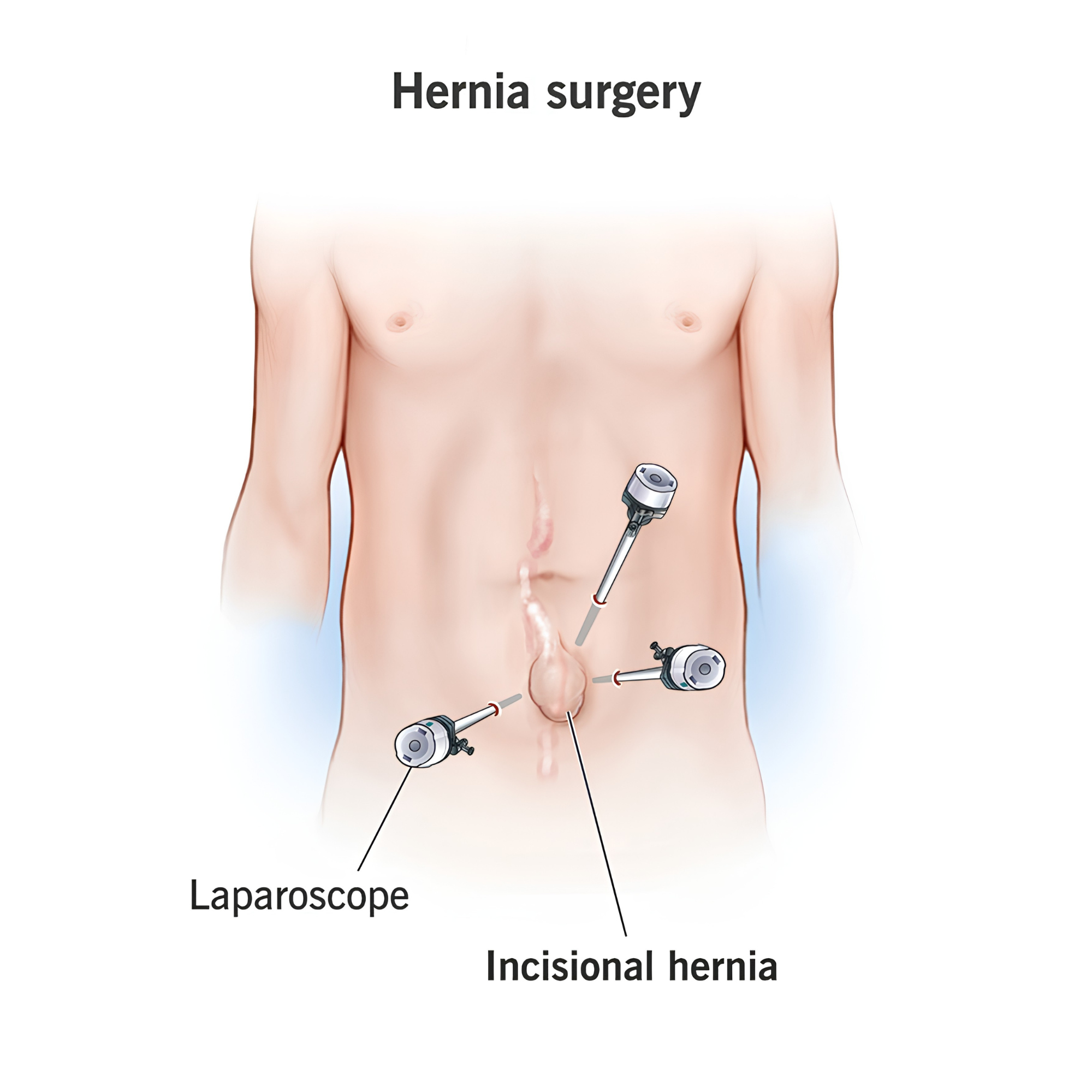Hernia repair — abdominal wall defect with surgical port positions