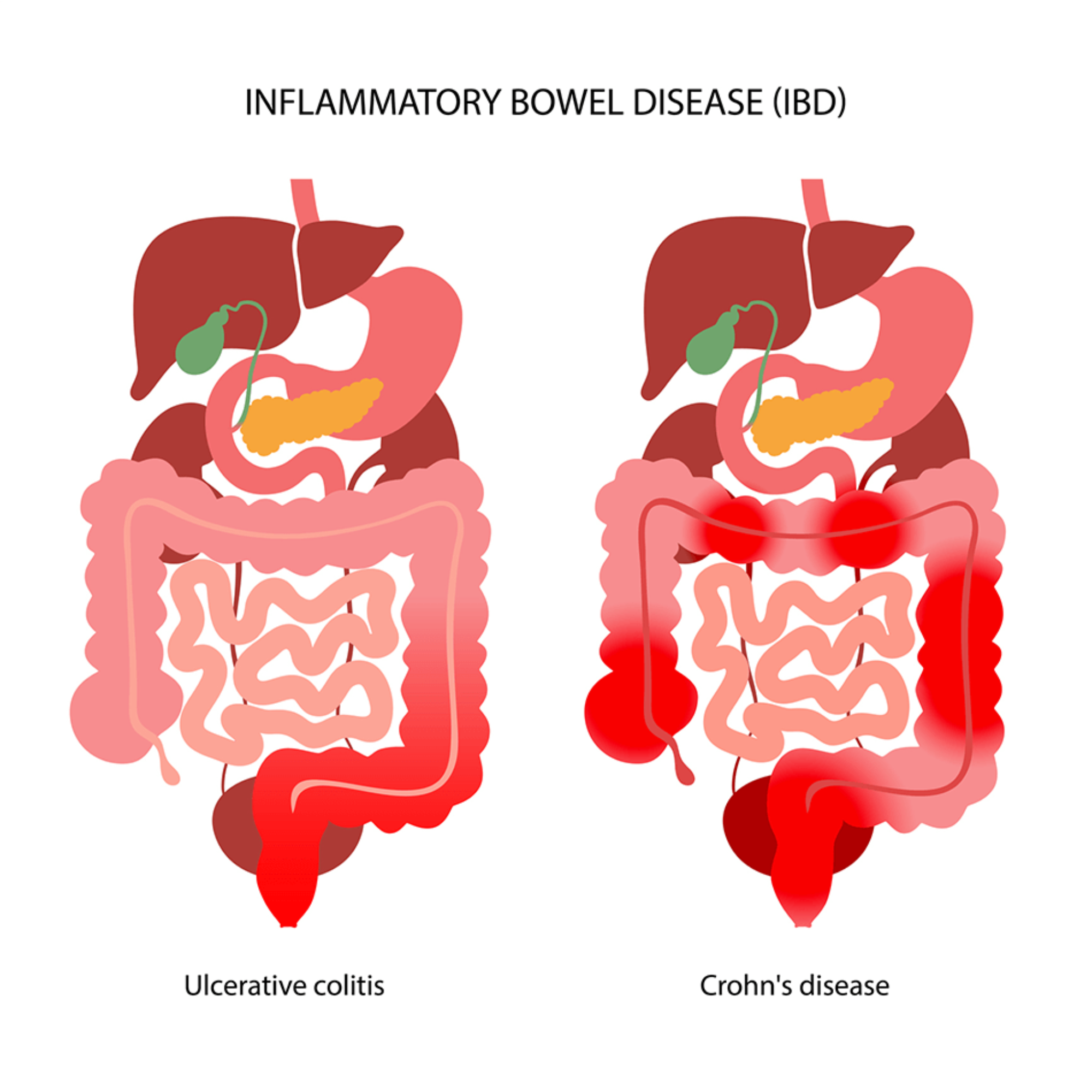 Ulcerative colitis and Crohn's disease — the two main types of inflammatory bowel disease, with their characteristic inflammation patterns