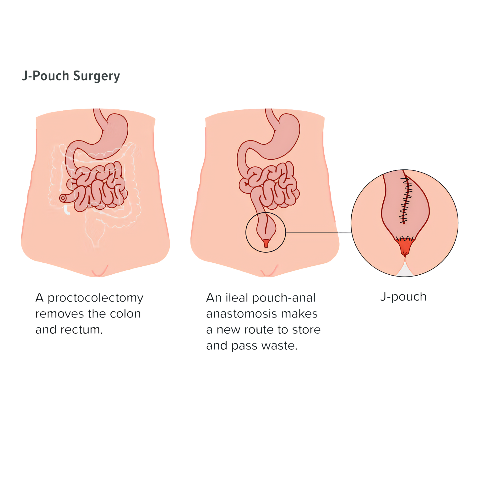 Panproctocolectomy with ileal pouch-anal anastomosis — the J-pouch reconstruction