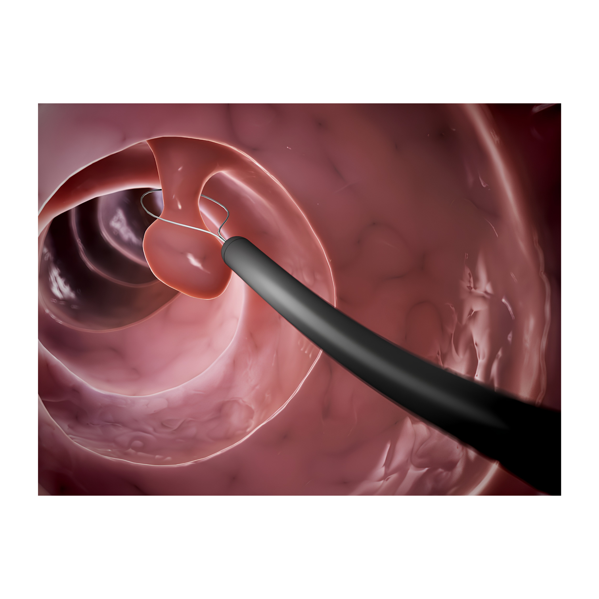 Endoscopic removal of a rectal lesion using a snare — the principle behind TAMIS