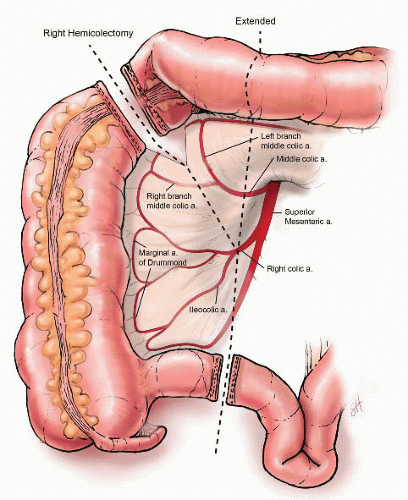 Right hemicolectomy — the right colon and the planned line of resection